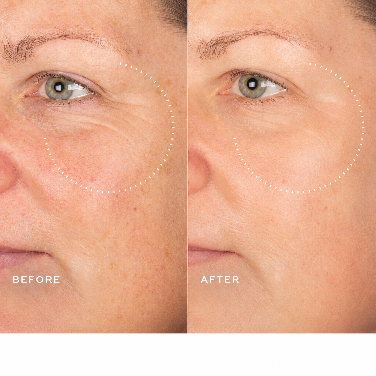 Before and after around the eye area after four weeks of nightly use